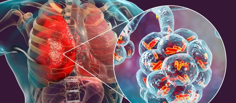 «Θερίζει» η «νόσος των λεγεωνάριων» το καλοκαίρι – Πως μπορείτε να προφυλαχτείτε (βίντεο)